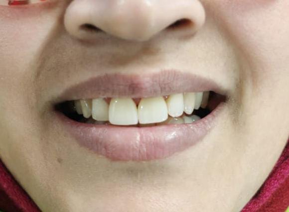 After treatment